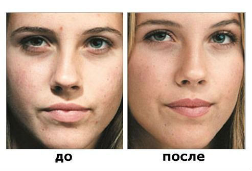 До и после применения салициловой кислоты До и после применения салициловой кислоты