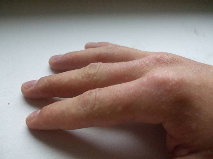 Мелкая сыпь между пальцами и на пальцах рук thumbnail