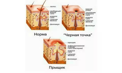Виды угрей на спине