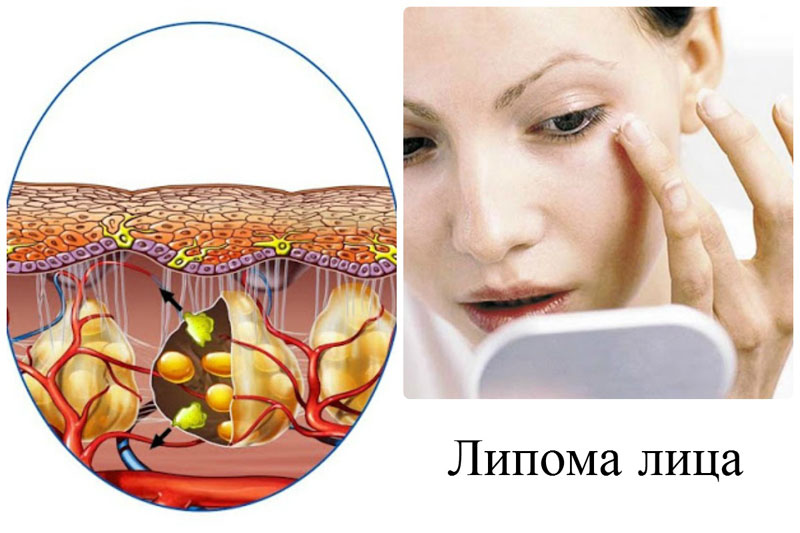 Липома на лице