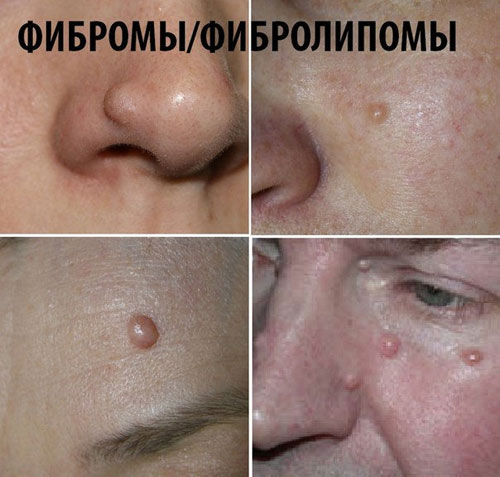 Фибромы и фибролипомы