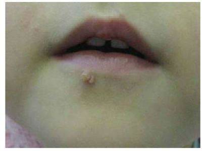 Папиллома на губе у ребенка