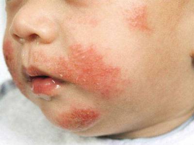 Аллергическая сыпь на лице у ребенка