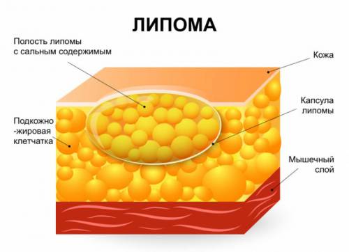 Образование жировика