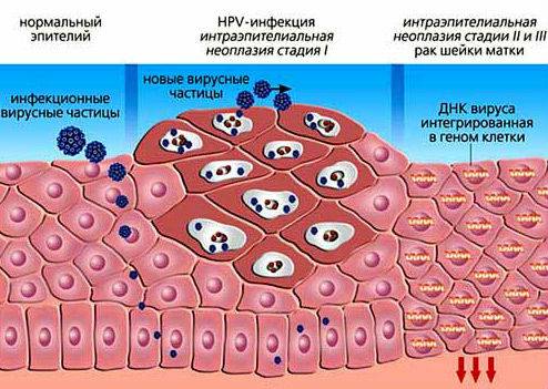 Развитие папилломы Развитие папилломы