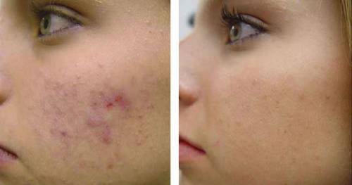 До и после лазерной чистки лица