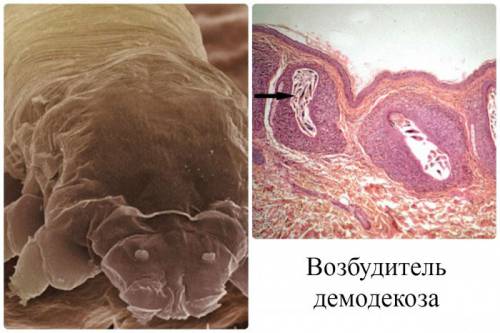 Клещ демодекс