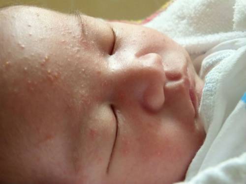 сыпь на лице у новорожденного