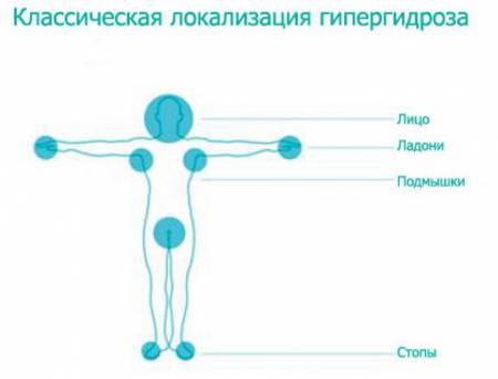 Локализация гипергидроза