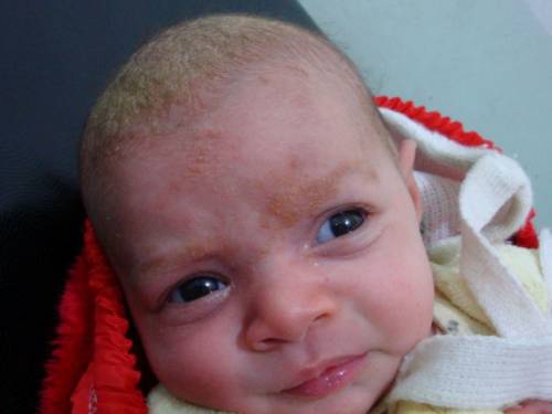 Шелушение кожи головы и лица у младенца