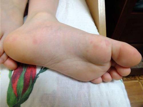 Сыпь на стопах ног в виде красных точек thumbnail