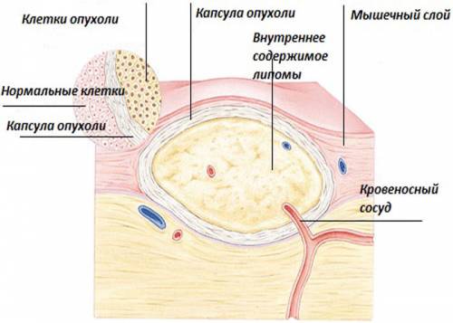 Липома