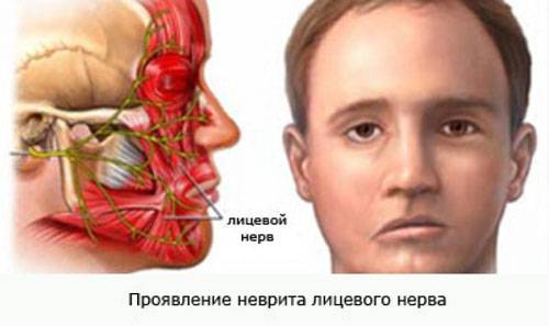 Неврит лицевого нерва
