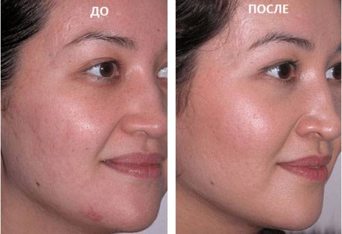 Лицо до салонных процедур и после
