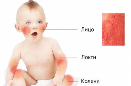 Локализация сыпи при детских болезнях
