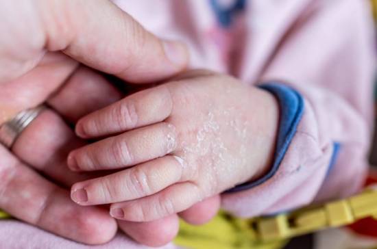 Шелушение кожи у ребенка на руках